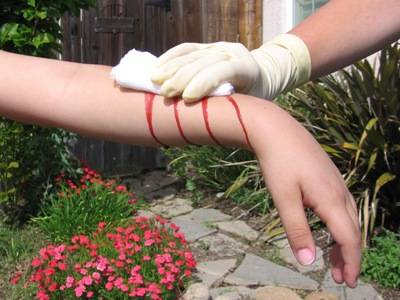 Bleeding Arm